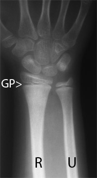 Children's Distal Radius Fractures